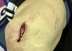 Americké cyklokrosařce kotoučovka rozřízla koleno na kost